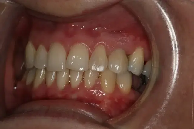 Dental Implants after at Rod Gleave DMD in Salt Lake City, UT