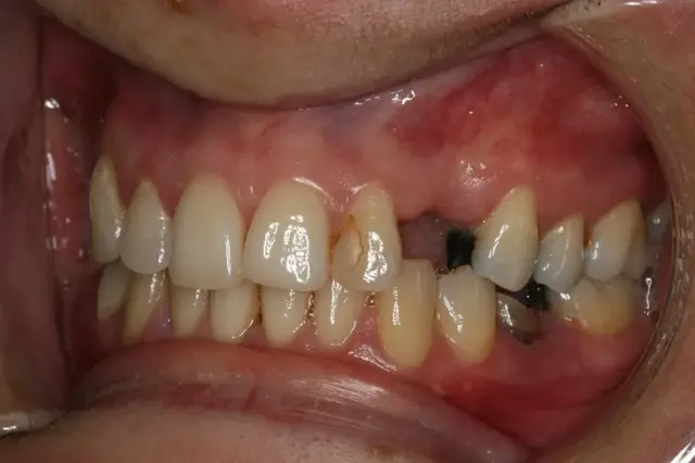 Dental Implants before at Rod Gleave DMD in Salt Lake City, UT
