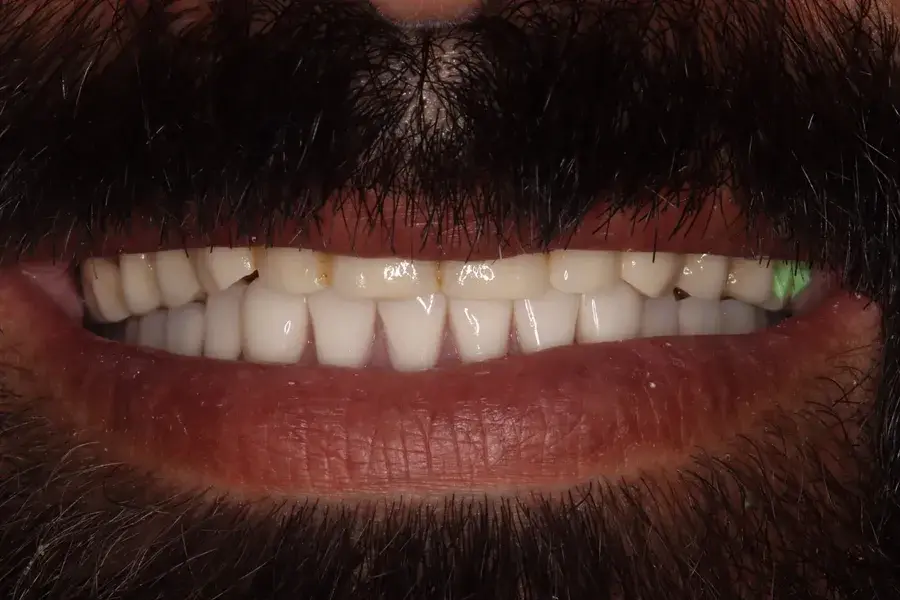 Rod Gleave DMD dental implants after — Salt Lake City, UT