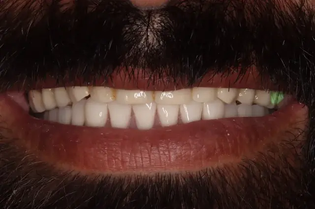 Dental Implants after at Rod Gleave DMD in Salt Lake City, UT