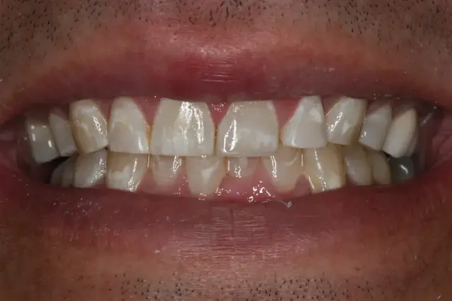 Invisalign after at Rod Gleave DMD in Salt Lake City, UT