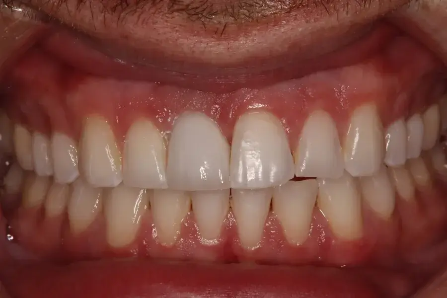 Rod Gleave DMD dental implants after — Salt Lake City, UT