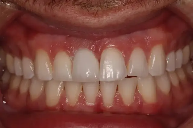 Dental Implants after at Rod Gleave DMD in Salt Lake City, UT