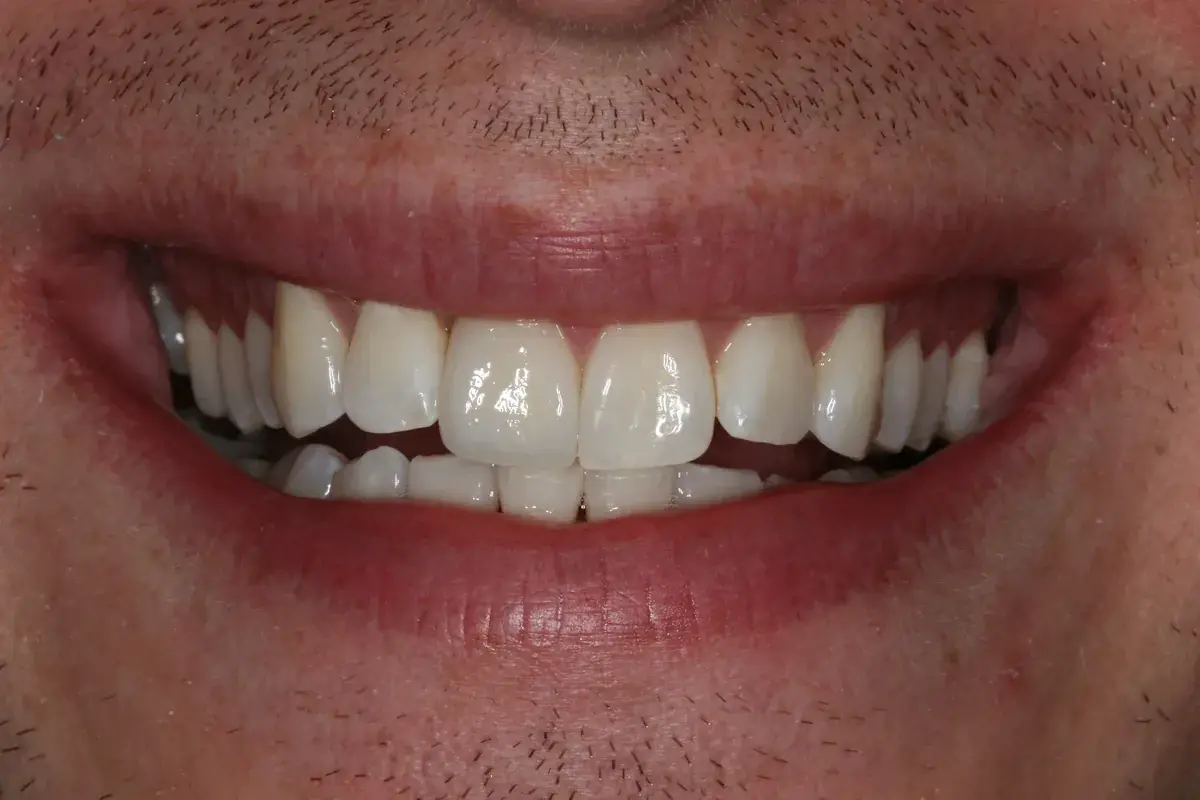 Rod Gleave DMD dental crowns after — Salt Lake City, UT