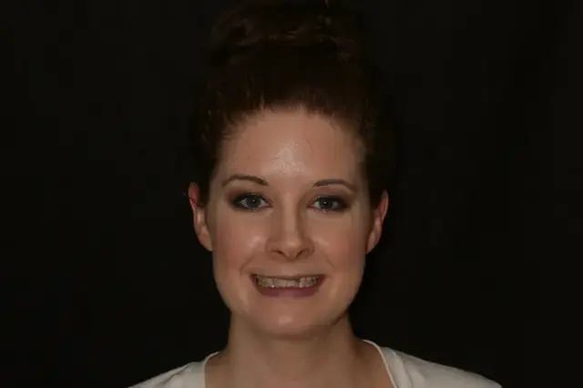 Smile Makeover before at Rod Gleave DMD in Salt Lake City, UT