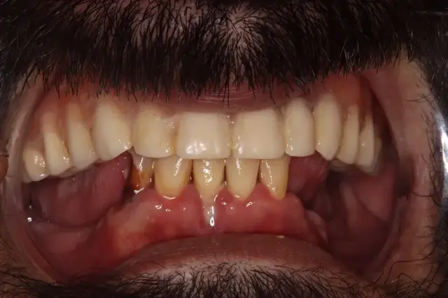 Dental Implants before at Rod Gleave DMD in Salt Lake City, UT