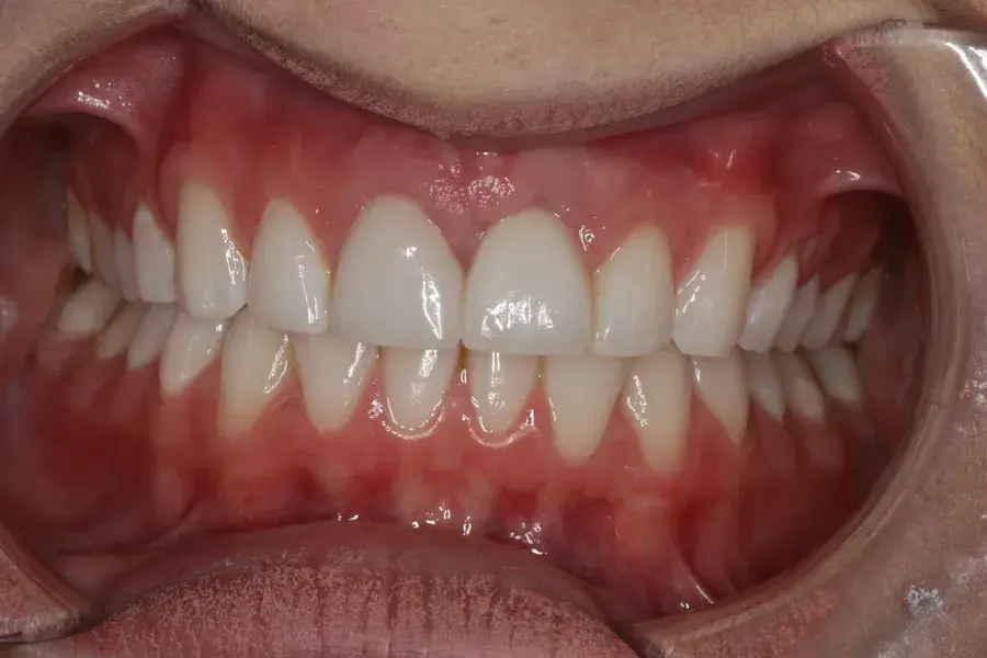 Rod Gleave DMD dental implants after — Salt Lake City, UT