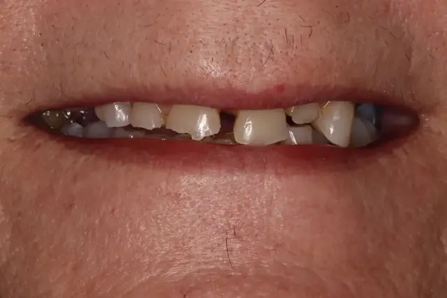 Dental Implants before at Rod Gleave DMD in Salt Lake City, UT