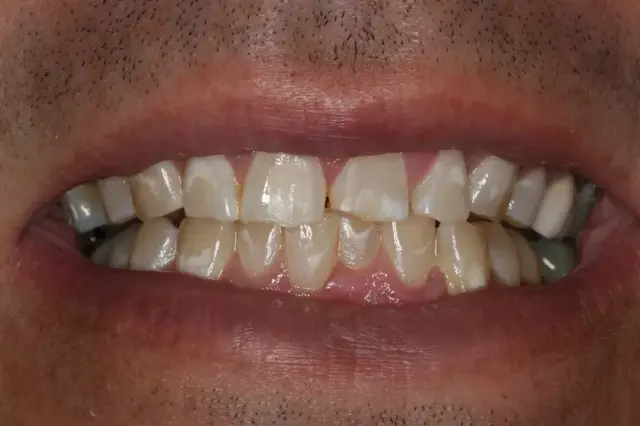 Invisalign before at Rod Gleave DMD in Salt Lake City, UT
