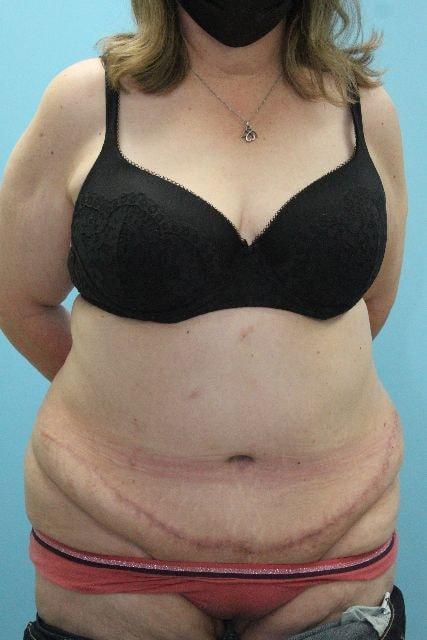UCI Plastic Surgery tummy tuck after — Tustin, CA