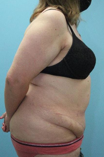 UCI Plastic Surgery tummy tuck after — Tustin, CA
