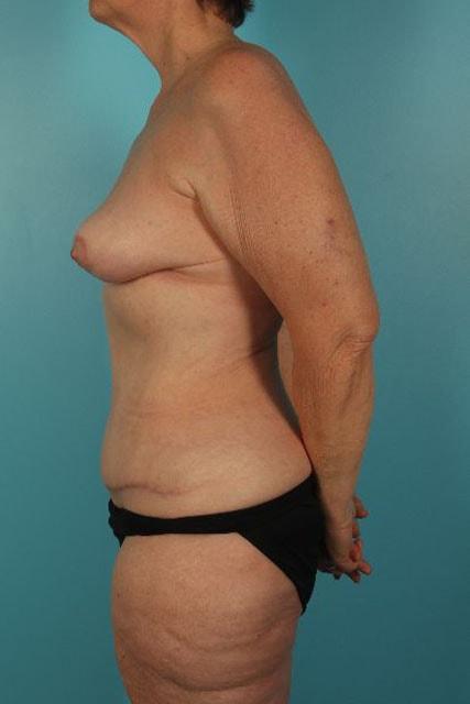 UCI Plastic Surgery mommy makeover after — Tustin, CA