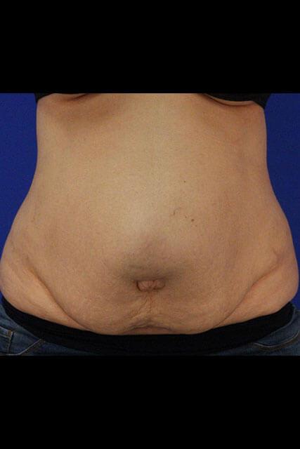 Tummy Tuck after at UCI Plastic Surgery in Tustin, CA