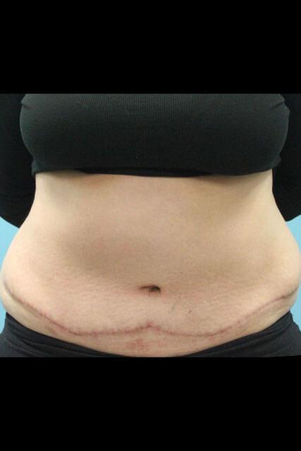 Tummy Tuck before at UCI Plastic Surgery in Tustin, CA