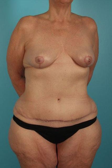 UCI Plastic Surgery mommy makeover after — Tustin, CA