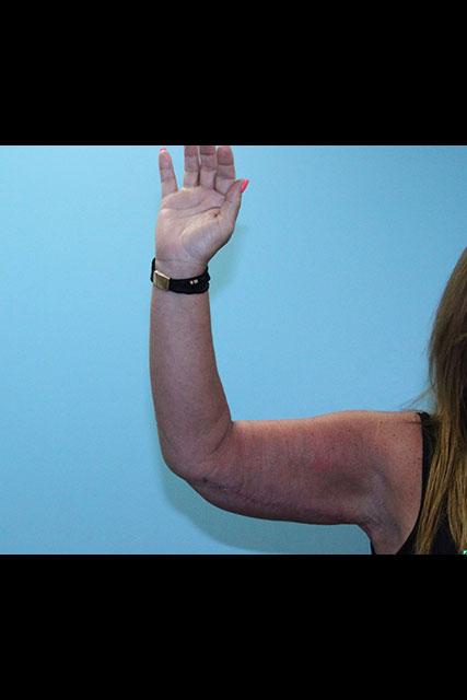Arm Lift after at UCI Plastic Surgery in Tustin, CA