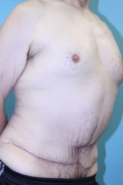 UCI Plastic Surgery tummy tuck after — Tustin, CA