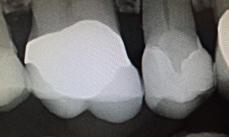 Formosa Dental Arts smile makeover after — Irvine, CA
