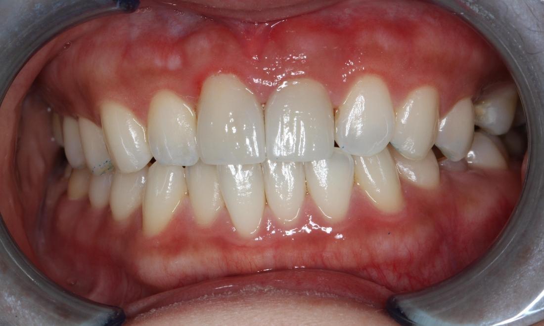 Formosa Dental Arts dental crowns after — Irvine, CA