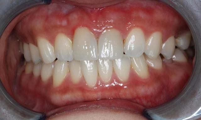 Dental Crowns after at Formosa Dental Arts in Irvine, CA