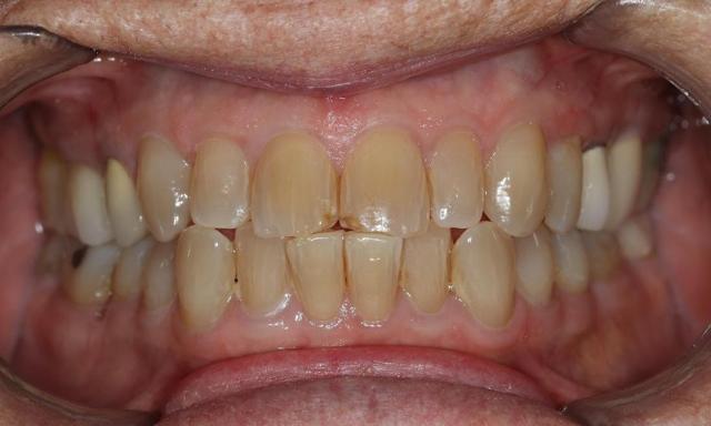Dental Crowns before at Formosa Dental Arts in Irvine, CA