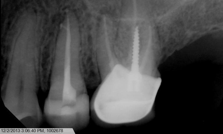 Formosa Dental Arts smile makeover after — Irvine, CA