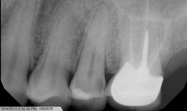 Smile Makeover before at Formosa Dental Arts in Irvine, CA