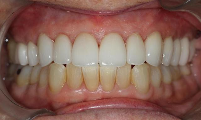 Dental Crowns after at Formosa Dental Arts in Irvine, CA