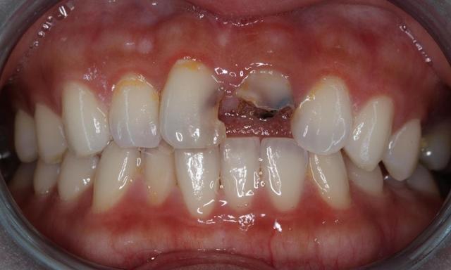 Dental Crowns before at Formosa Dental Arts in Irvine, CA