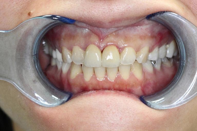Formosa Dental Arts dental crowns after — Irvine, CA