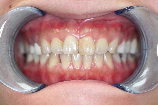 Dental Crowns before at Formosa Dental Arts in Irvine, CA