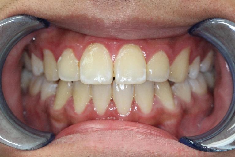 Formosa Dental Arts smile makeover after — Irvine, CA