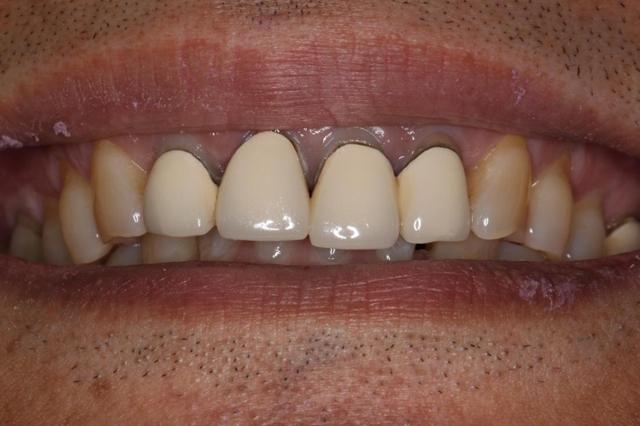 Dental Crowns before at Formosa Dental Arts in Irvine, CA
