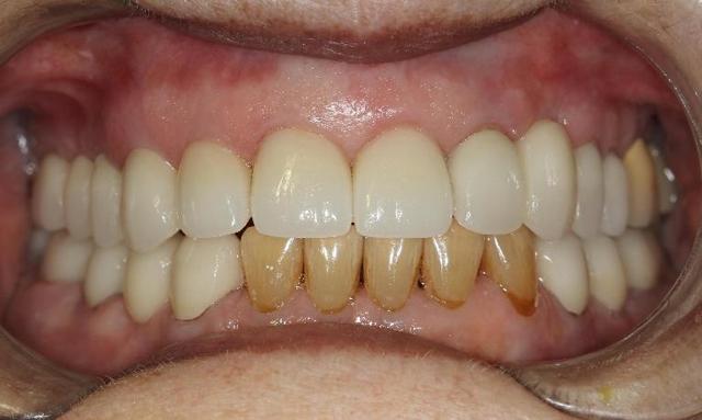 Smile Makeover after at Formosa Dental Arts in Irvine, CA