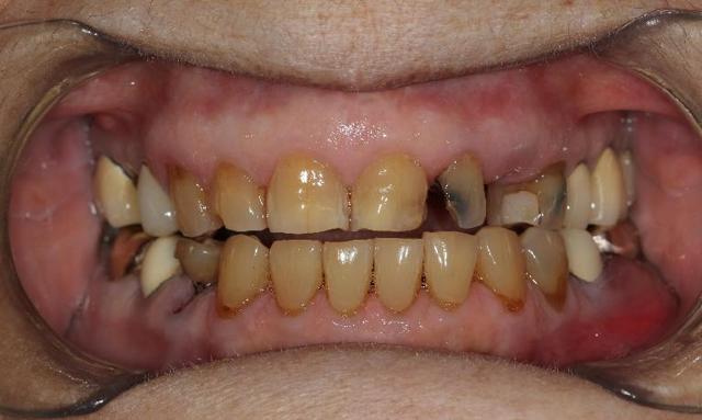 Smile Makeover before at Formosa Dental Arts in Irvine, CA