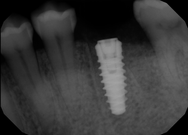 Dental Implants after at Formosa Dental Arts in Irvine, CA