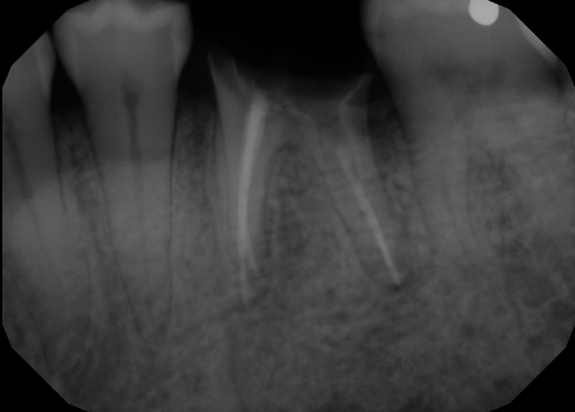 Dental Implants before at Formosa Dental Arts in Irvine, CA