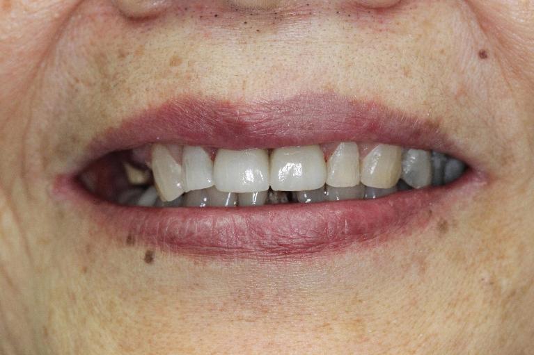 Formosa Dental Arts dental crowns after — Irvine, CA