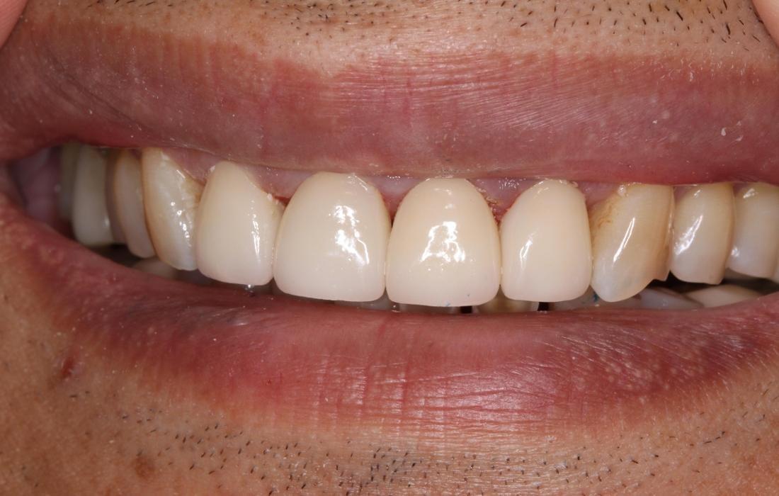 Formosa Dental Arts dental crowns after — Irvine, CA