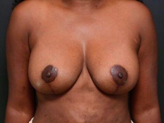 Linville Plastic Surgery breast lift after — Houston, TX