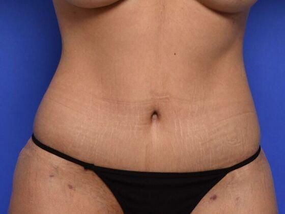 Linville Plastic Surgery tummy tuck after — Houston, TX