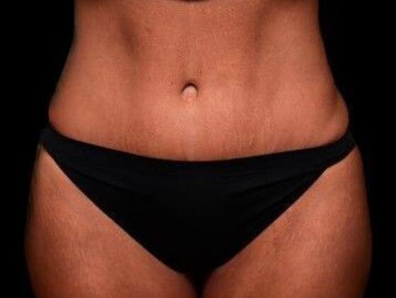 Linville Plastic Surgery tummy tuck after — Houston, TX