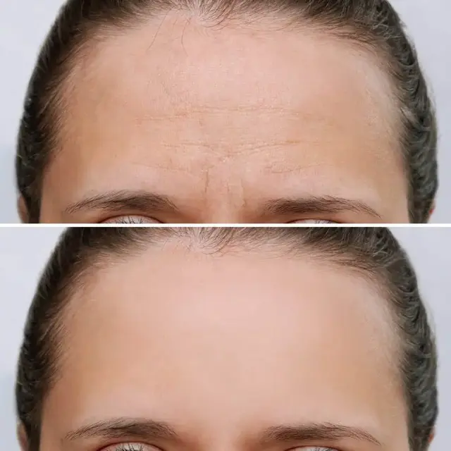 Botox result at U Beauty Med Clinic - Midvale UT in Midvale, UT