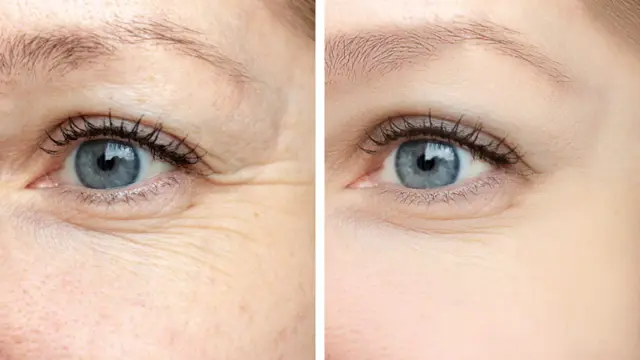 Botox result at U Beauty Med Clinic - Midvale UT in Midvale, UT