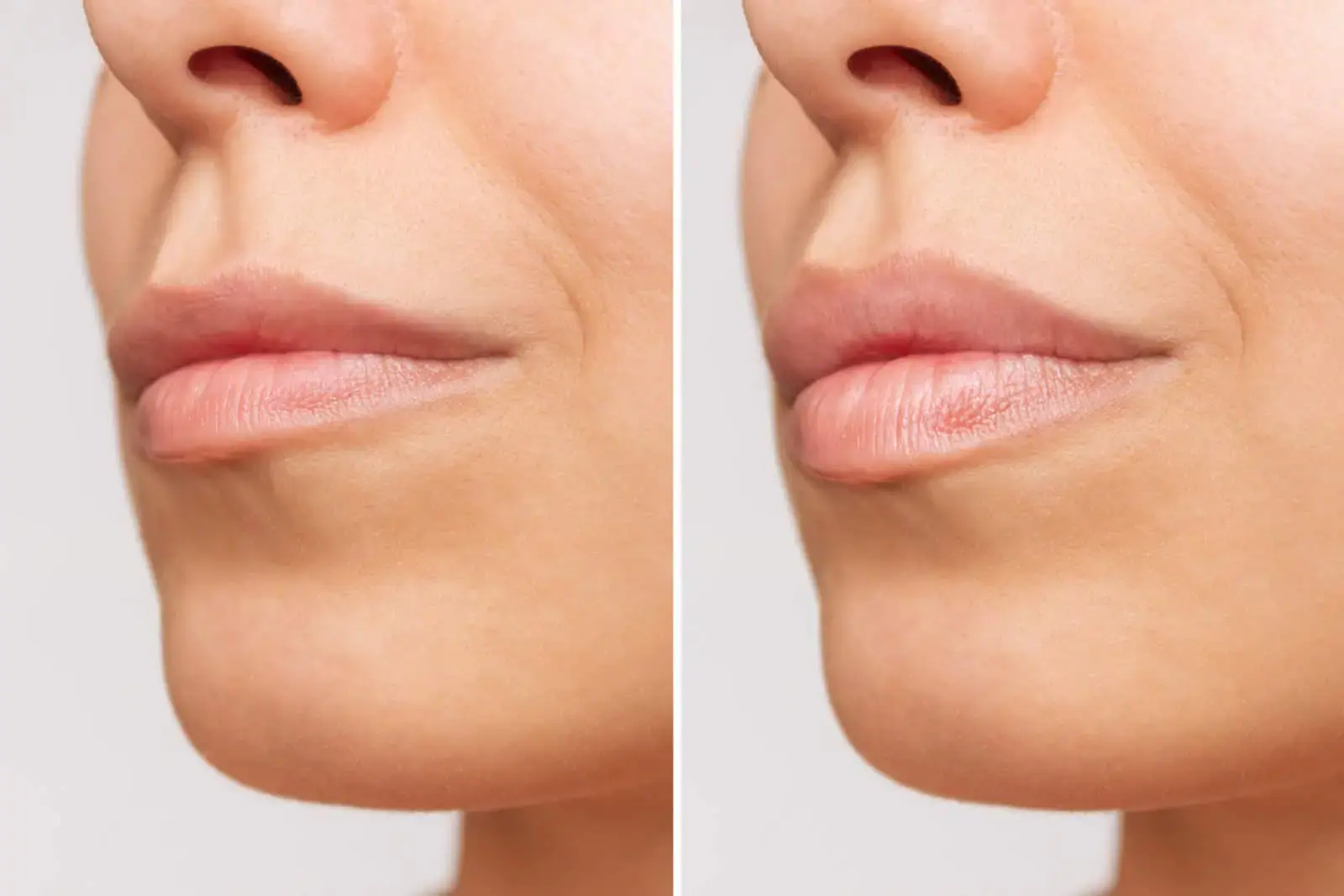 U Beauty Med Clinic - Midvale UT lip filler result — Midvale, UT