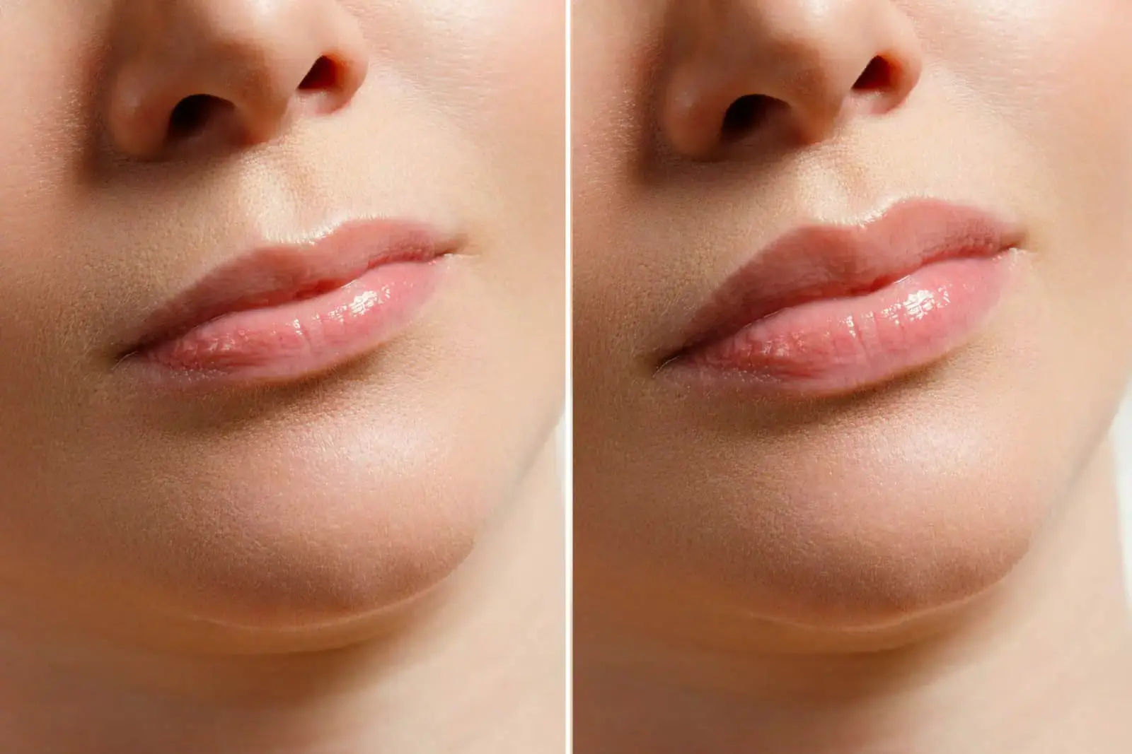 U Beauty Med Clinic - Midvale UT lip filler result — Midvale, UT