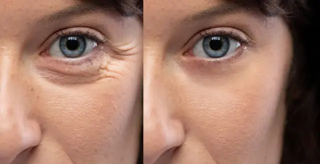 Botox result at U Beauty Med Clinic - Midvale UT in Midvale, UT