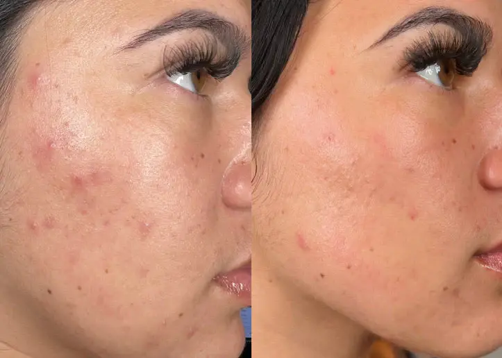U Beauty Med Clinic - Midvale UT result — Midvale, UT