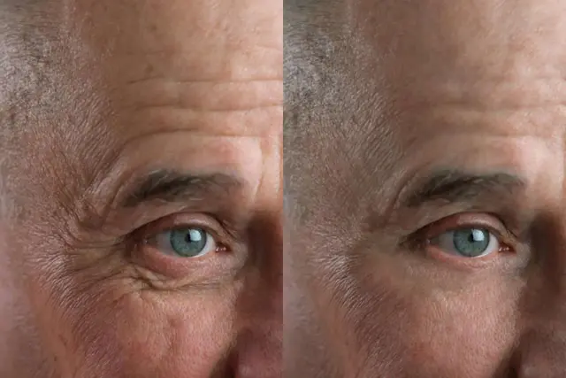 Botox result at U Beauty Med Clinic - Midvale UT in Midvale, UT