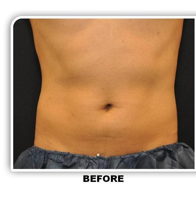 CoolSculpting before at La Jolla Plastic Surgery & Dermatology in San Diego, CA